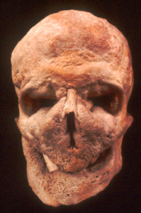 An image of a skull deformed by Paget’s disease. In this condition the bone is abnormally thick because of huge growth. This could have been the same condition which the Viking Egil had, allowing him to withstand axe blows to the head. Courtesy of Scientific American.