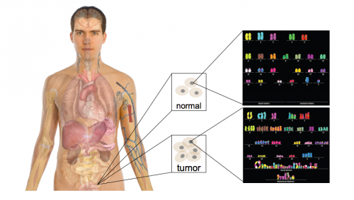 The contrast between a normal genome and a cancer genome is depicted in an individual. The cancer genome is clearly distorted and did not replicate properly. The goal is to find out which key mutations lead to the development of such rogue tumor cells with grossly distorted genomes. Courtesy of Mark Gerstein.