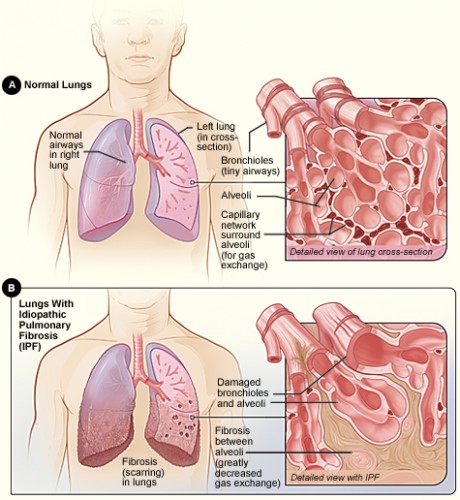 A comparison of normal and IPF-diseased lungs. Courtesy of National Institutes of Health.