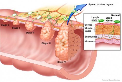 The various stages of colorectal cancer. The Crawford lab has recently received a grant to investigate the role of E. coli and small molecules it produces in driving this cancer forwards. Photo courtesy of the National Cancer Institute. 