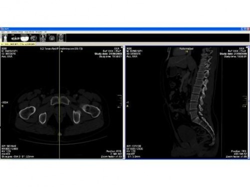 These two scans focus on different regions of the pubis. The new computing system analyzes these images to determine the age and sex of the corpse (this one is most likely a male around age 50). Courtesy of Science Daily.