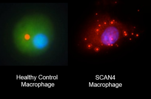 1.The inflammatory machinery in immune cells carrying the NLRC4 mutation fails to assembly correctly (right), in contrast to healthy cells. Image Courtesy of Neil Romberg.