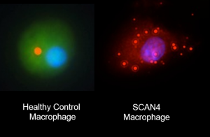 1.The inflammatory machinery in immune cells carrying the NLRC4 mutation fails to assembly correctly (right), in contrast to healthy cells. Image Courtesy of Neil Romberg. 