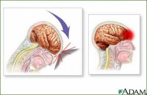 A concussion occurs when the brain smashes into the skull, causing bruising and swelling. Image courtesy of whyfiles.org.