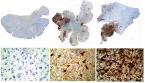 On the left, the brain section and microscopic section below are from an individual with no CTE. On the right, two athletes show deposits of tau protein, which kills neurons and is characteristic of CTE. Image courtesy of Boston University CTE center.