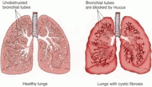 In cystic fibrosis patients, mucus build up impairs lung function by blocking airways. The mucus also traps pathogens that we inhale instead of clearing them out of the lungs, causing frequent lung infections. Image courtesy of Case it Conferencing.