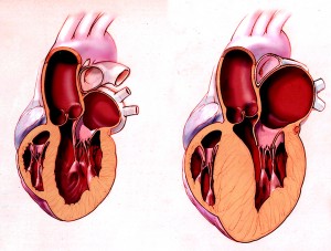 Late development of a thickened heart wall can complicate correct diagnosis of a diseased heart. Image courtesy of Geneva Foundation for Medical Education and Research.