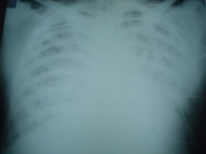 An x-ray of a leptospirosis patient shows massive pulmonary bleeding, an often fatal latter-stage symptom of the disease. Image courtesy of Albert Ko.