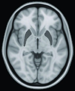 In the study conducted by Levy’s team, brain volume and hippocampus size were monitored using MRIs like the one seen here. Source: Wikimedia Commons