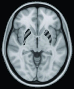 In the study conducted by Levy’s team, brain volume and hippocampus size were monitored using MRIs like the one seen here. Source: Wikimedia Commons